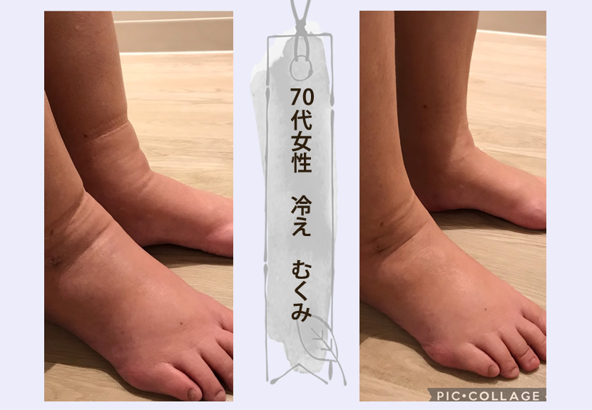 70代女性 冷え むくみ