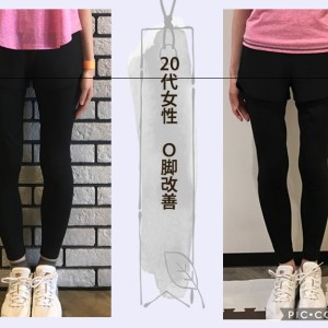 20代女性 O脚改善