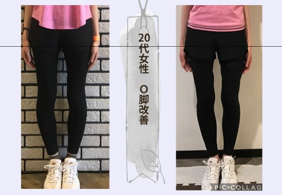 20代女性 O脚改善
