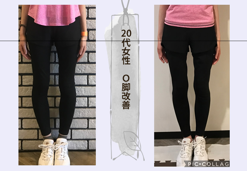20代女性 O脚改善
