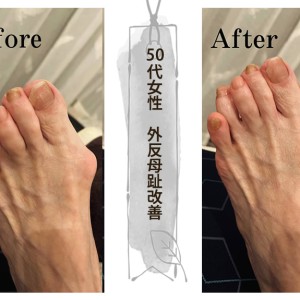 外反母趾改善