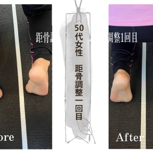 距骨調整
