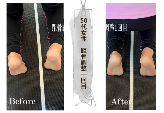 距骨調整