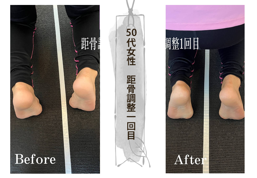 距骨調整